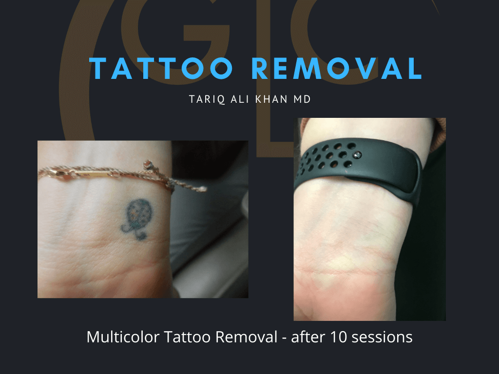 Gentle Care Laser Tustin Before and After picture - Tattoo Removal Mucosal Surface